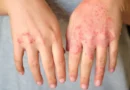 Dermatite atópica impacta pele, sono e autoestima: saiba como tratar Dermatite atópica impacta pele, sono e autoestima: saiba como tratar