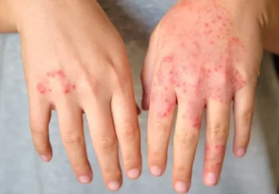 Dermatite atópica impacta pele, sono e autoestima: saiba como tratar Dermatite atópica impacta pele, sono e autoestima: saiba como tratar