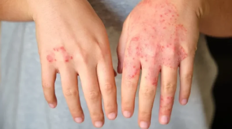 Dermatite atópica impacta pele, sono e autoestima: saiba como tratar Dermatite atópica impacta pele, sono e autoestima: saiba como tratar